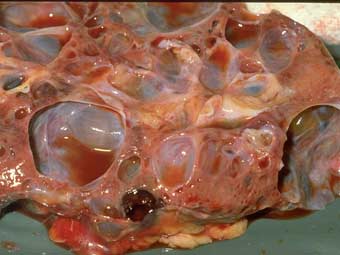 АДПКБП, макропрепарат (фото - интернет).