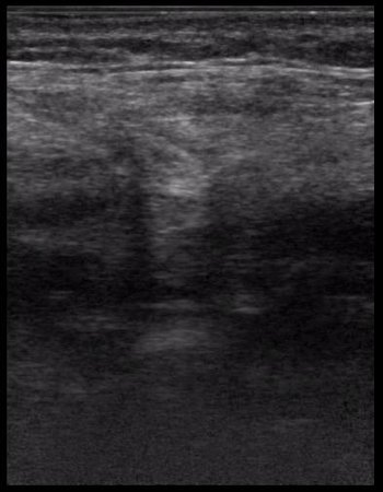 абсцесс передней брюшной стенки (через 2 недели п.о.)