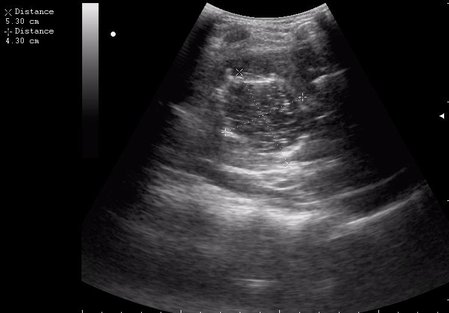 нагноение остаточной полости