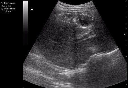 спустя 8 мес. после операции