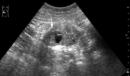 При ультрасонографии в нижнем полюсе правой почки обнаружена киста с тканевым компонентом (стрелка)