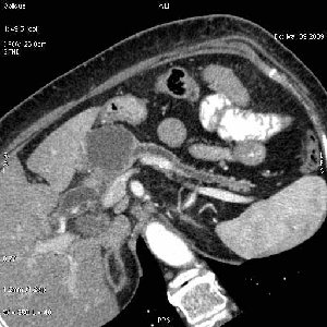 КТ-реконструкция
