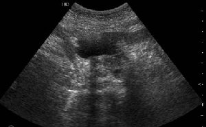 Сонограмма панкреас, ее продольное сканирование.