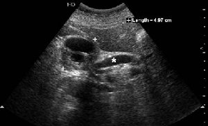 Сонограмма панкреас, косое сканирование. Образование головки сдавливает холедох (*)