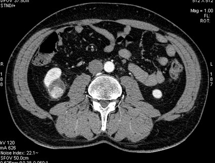 При КТ с контрастированием тканевой компонент активно накапливает контраст