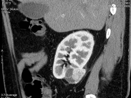 КТ- реконструкция