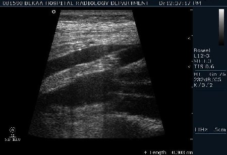 Нормальный аппендикс