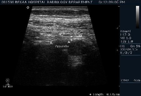 Нормальный аппендикс