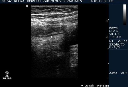 Острый аппендицит 1