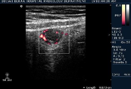 Острый аппендицит 1