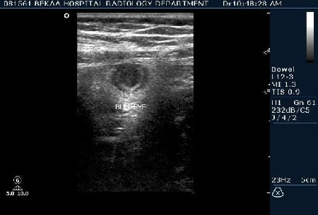 Острый аппендицит 1 (Bull-eye sign)