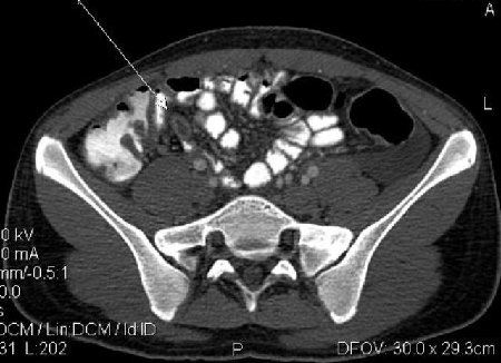 Острый аппендицит, КТ