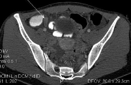 Острый аппендицит, КТ