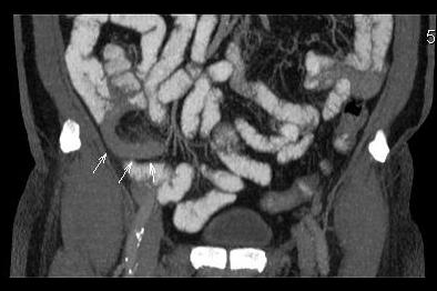 Острый аппендицит, КТ MPR coronal
