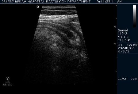 Острый аппендицит 2