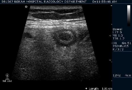 Острый аппендицит 2