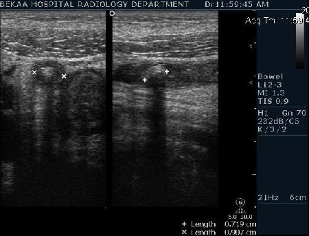 Острый аппендицит с аппендоколитами