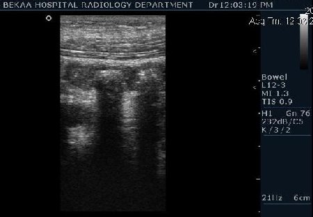 Острый аппендицит с аппендоколитами