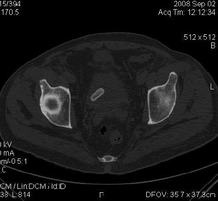 Bladder foreign body0001.jpg
