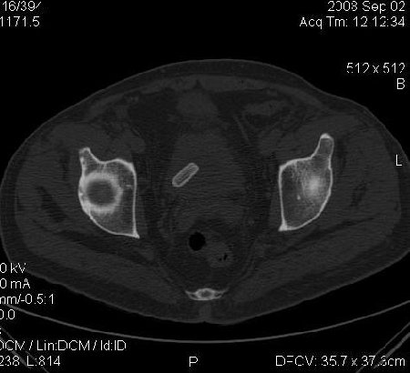 Bladder foreign body0002.jpg
