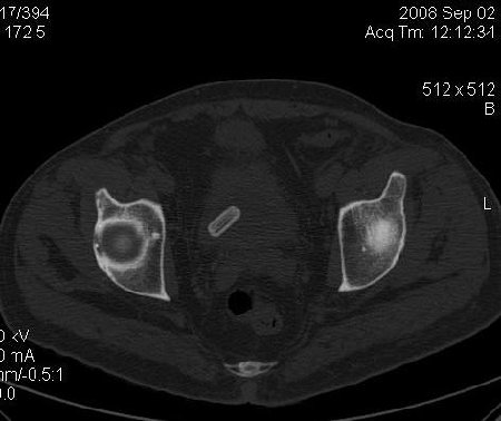 Bladder foreign body0003.jpg