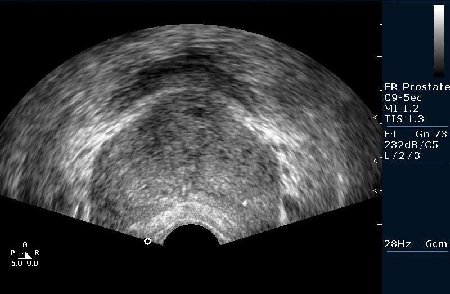 Предстательная железа