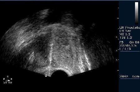 Биопсийная игла в железе (трепан биопсия)