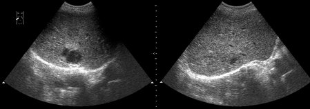 Маленький абсцесс печени до и на фоне 1 недели АБ-терапии