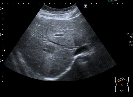 Очаговые изменения в  печени