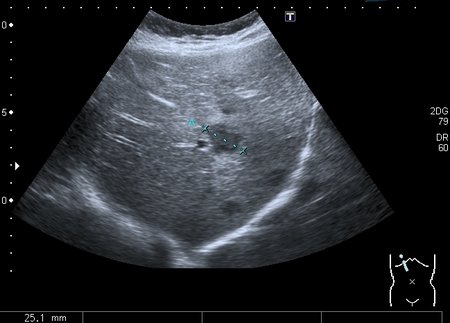Очаговые изменения в  печени