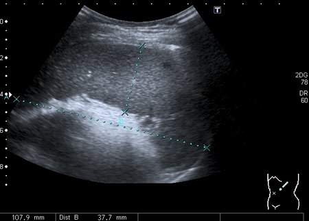 Спленомегалия