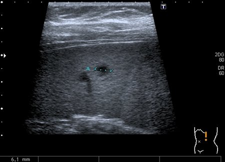 Очаговые изменения в селезёнке