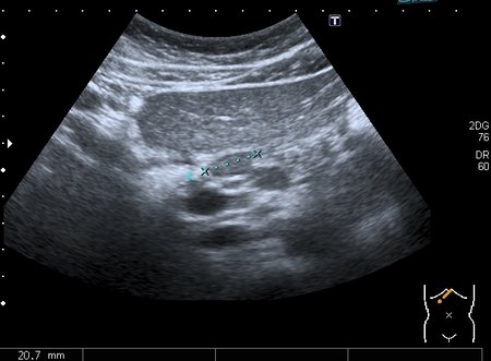 Лимфатические узлы в воротах   печени