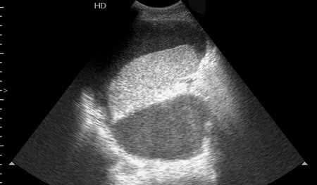 Сонограмма селезенки. Продольное сканирование из левого бокового доступа.