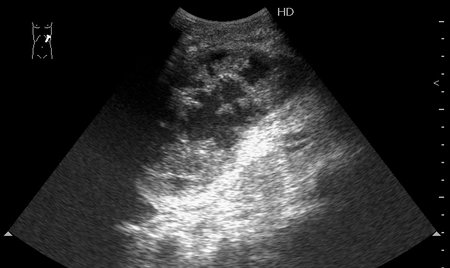 УЗИ селезенки, продольное сканирование