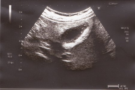 желчный в поперечнике.