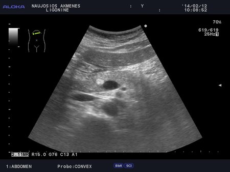 qqqq_20140212_ABDOMEN_0011.JPG
