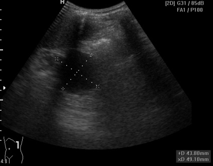 в проекции хвоста поджелудочной железы