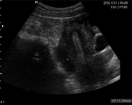 в малом тазу жидкость мелкодисперстная
