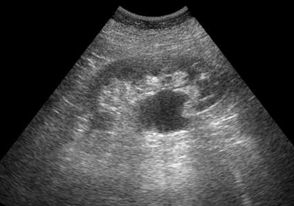 Сонограмма левой почки