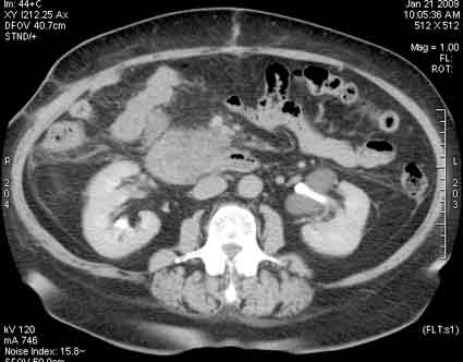 КТ с контрастированием (отсроченная фаза)