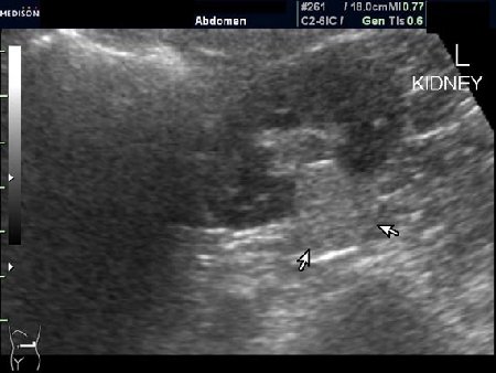 Образование в левой почке