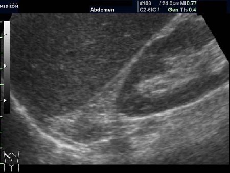 Область правого надпочечника