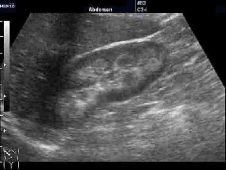 Правая почка.