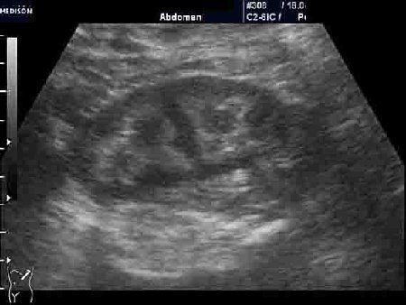 Левая почка.