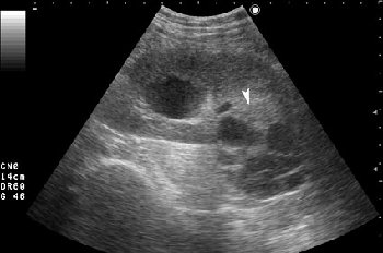 Серошкальное УЗИ. В области нижнего полюса определяется образование сложной структуры (стрелка).