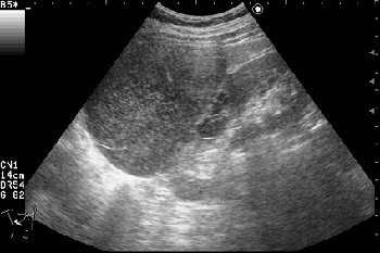 Сонограмма правой почки.