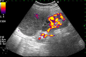 Образование в режиме энергетического доплера.