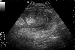 Продольная сонограмма левой почки.