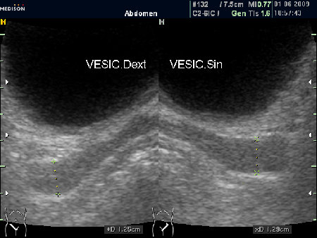 Нормальные СП (ТА УЗИ)